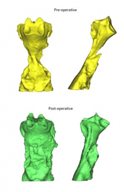 The pre-operative and post-operative airway images, showing a significant increase in the airway volume after SMA.
 